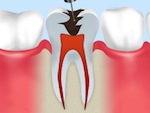 歯ぐきに麻酔をかけ、歯の神経を確認します。